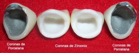 Diferencia entre Coronas Metal Porcelana y Coronas de Zirconio - Doctor  Neguib